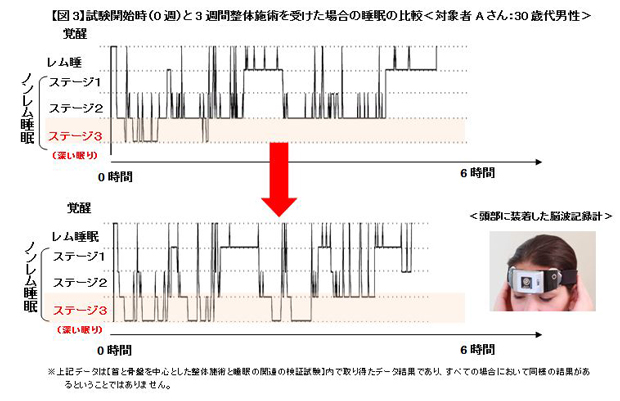 【図3】試験開始時(0週)と3週間整体施術を受けた場合の睡眠の比較<対象者Aさん:30歳代男性>